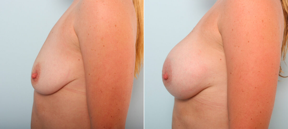 Breast Augmentation before and after photos in Houston, TX, Patient 42051