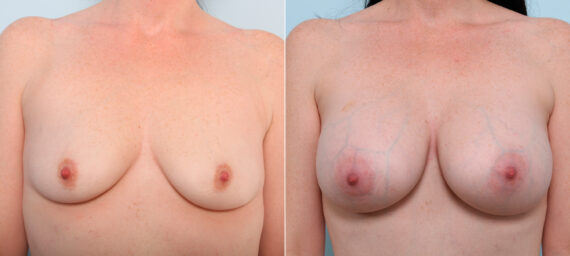Breast Augmentation before and after photos in Houston, TX, Patient 42072