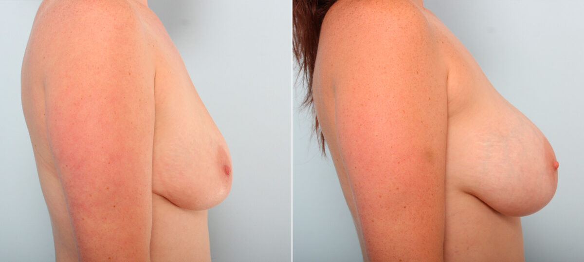Breast Augmentation before and after photos in Houston, TX, Patient 42077