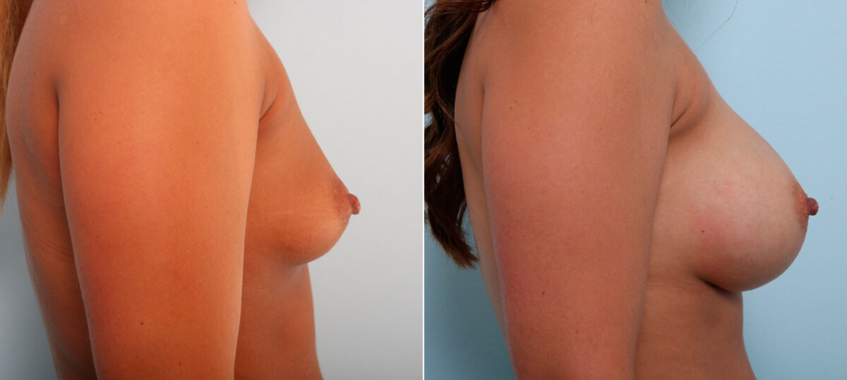 Breast Augmentation before and after photos in Houston, TX, Patient 42098