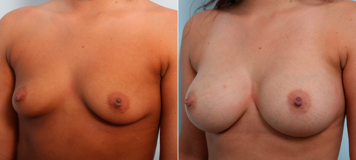 Breast Augmentation before and after photos in Houston, TX, Patient 42098