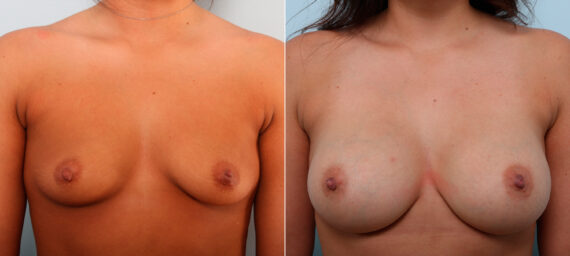 Breast Augmentation before and after photos in Houston, TX, Patient 42098