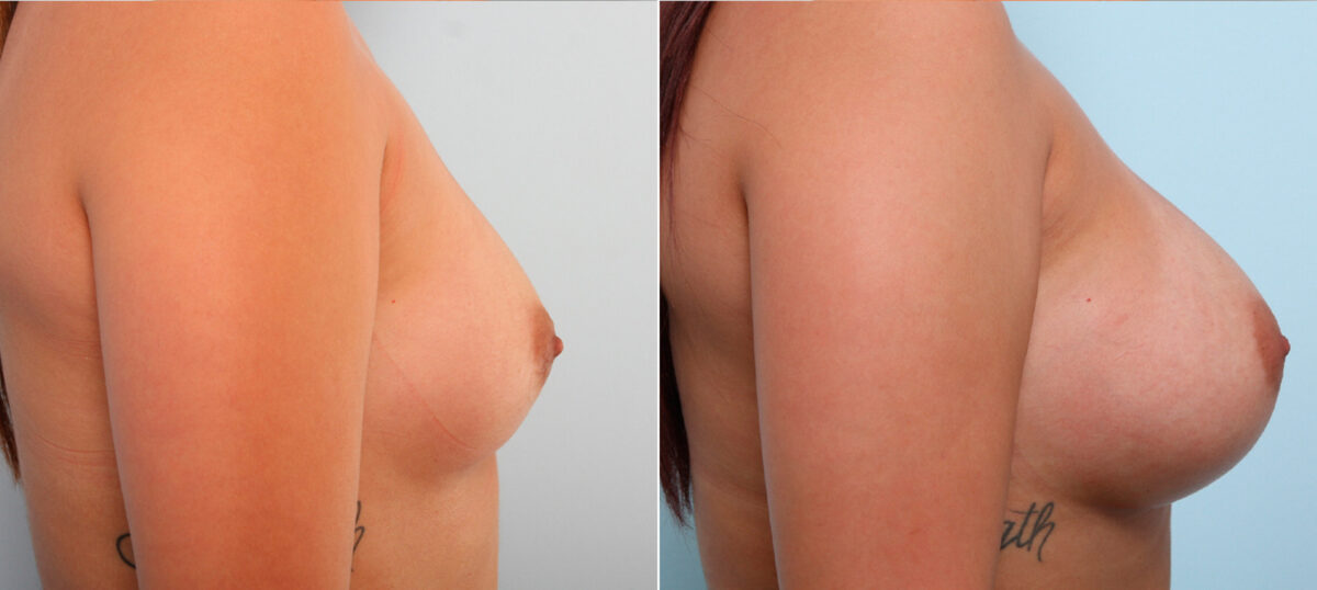 Breast Augmentation before and after photos in Houston, TX, Patient 42119