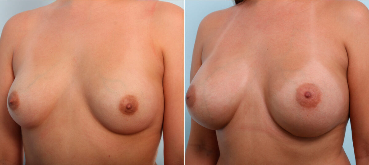 Breast Augmentation before and after photos in Houston, TX, Patient 42119