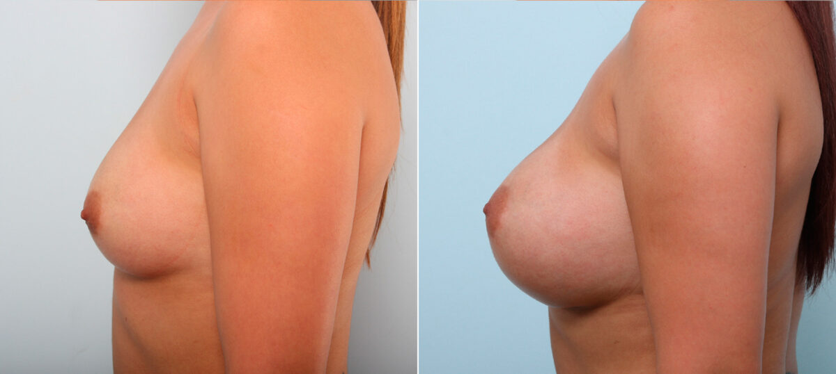 Breast Augmentation before and after photos in Houston, TX, Patient 42119