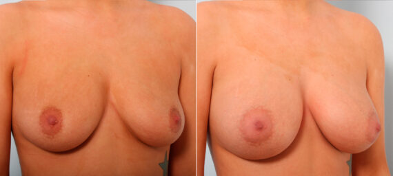 Breast Augmentation before and after photos in Houston, TX, Patient 42140