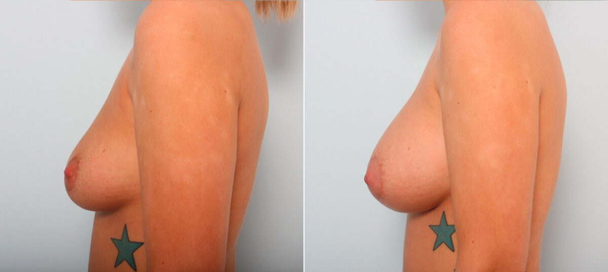 Breast Augmentation before and after photos in Houston, TX, Patient 42140
