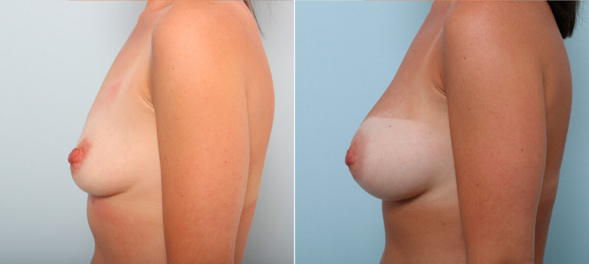 Breast Augmentation before and after photos in Houston, TX, Patient 42161