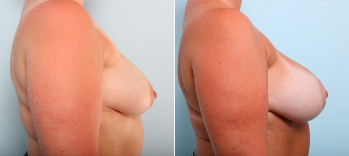 Breast Augmentation before and after photos in Houston, TX, Patient 42182