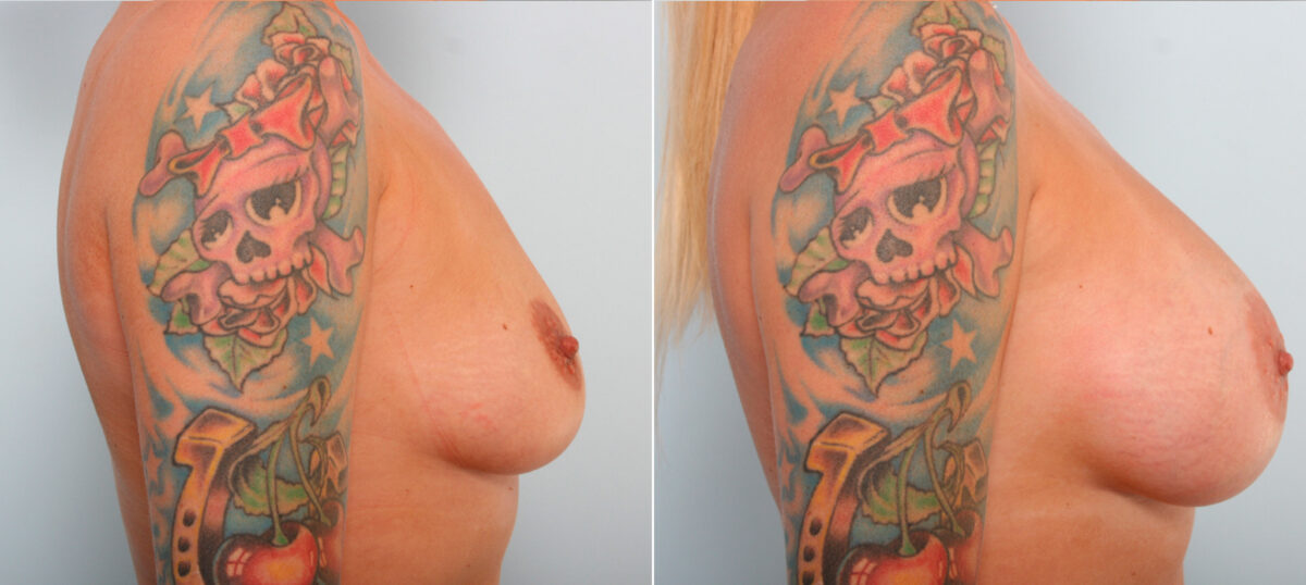 Breast Augmentation before and after photos in Houston, TX, Patient 42203