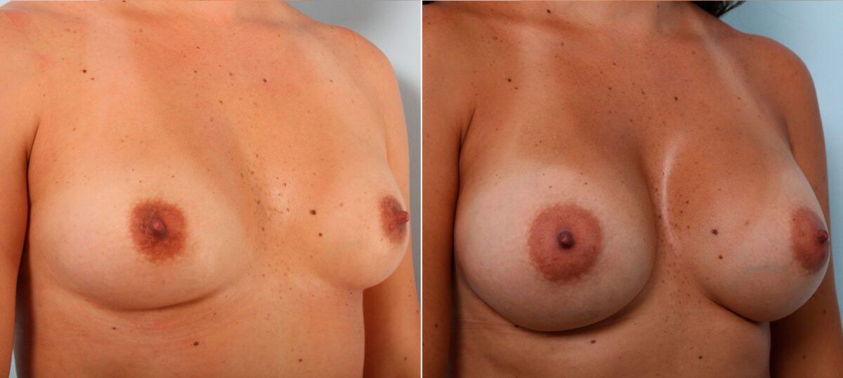 Breast Augmentation before and after photos in Houston, TX, Patient 42224