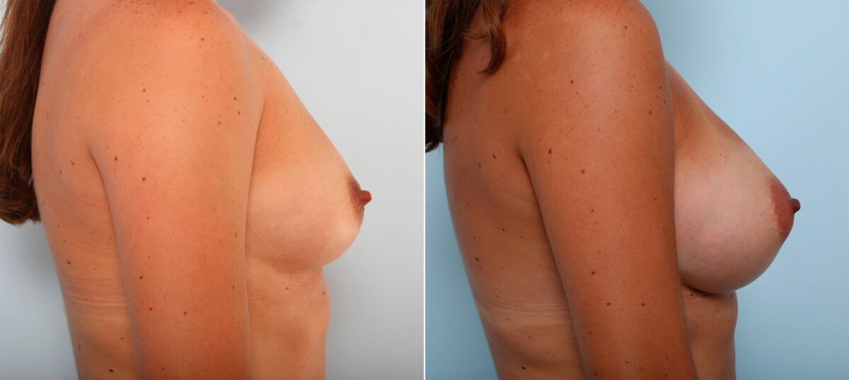 Breast Augmentation before and after photos in Houston, TX, Patient 42224