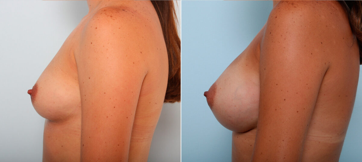 Breast Augmentation before and after photos in Houston, TX, Patient 42224