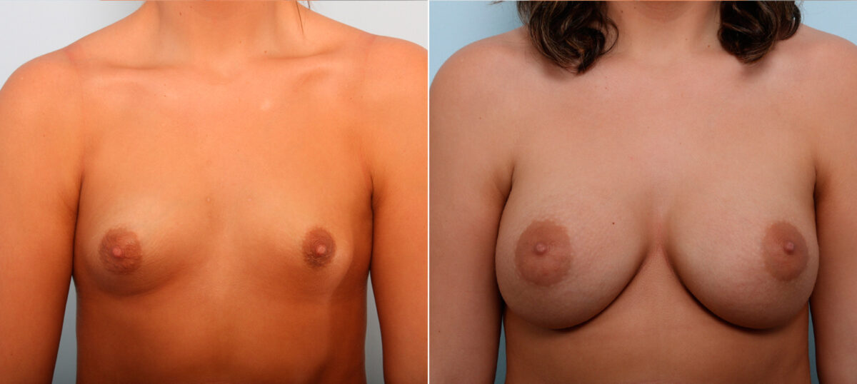 Breast Augmentation before and after photos in Houston, TX, Patient 42245