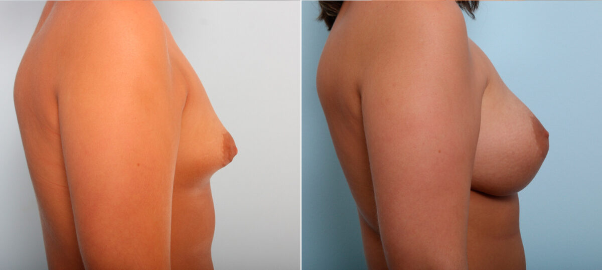 Breast Augmentation before and after photos in Houston, TX, Patient 42245