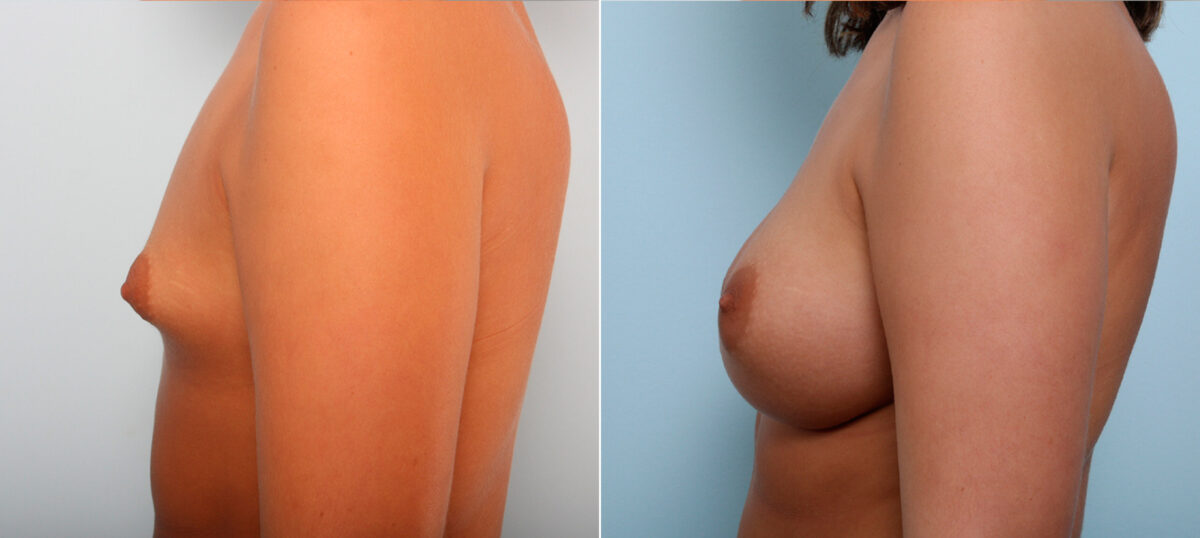 Breast Augmentation before and after photos in Houston, TX, Patient 42245