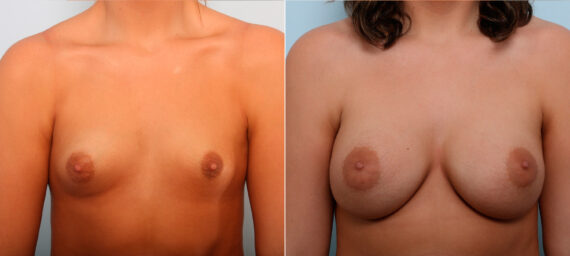 Breast Augmentation before and after photos in Houston, TX, Patient 42245