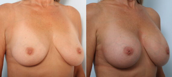 Breast Augmentation before and after photos in Houston, TX, Patient 42266