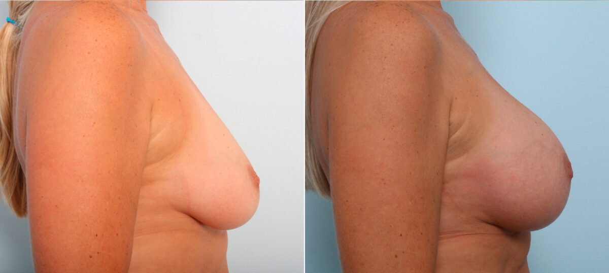 Breast Augmentation before and after photos in Houston, TX, Patient 42266