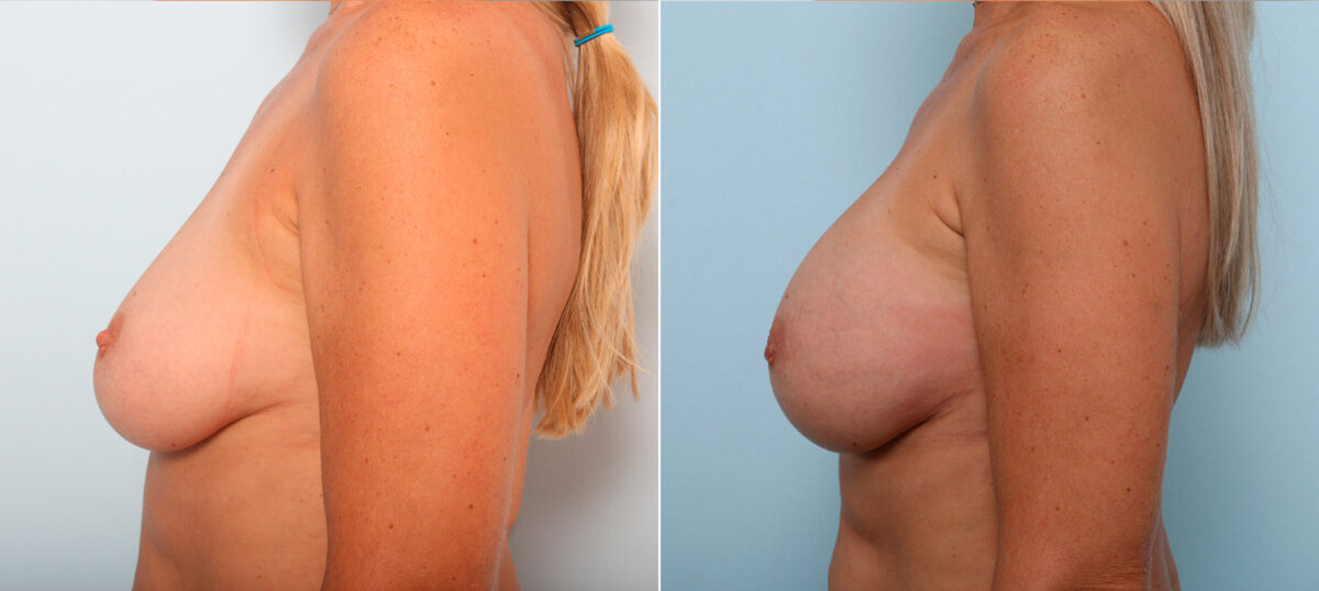 Breast Augmentation before and after photos in Houston, TX, Patient 42266