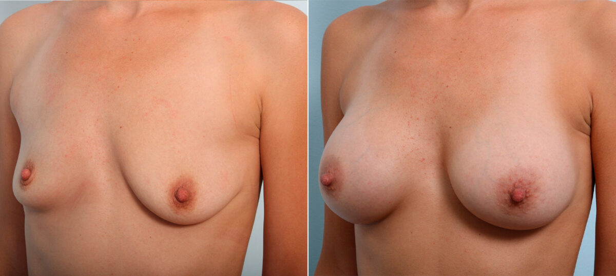 Breast Augmentation before and after photos in Houston, TX, Patient 42287