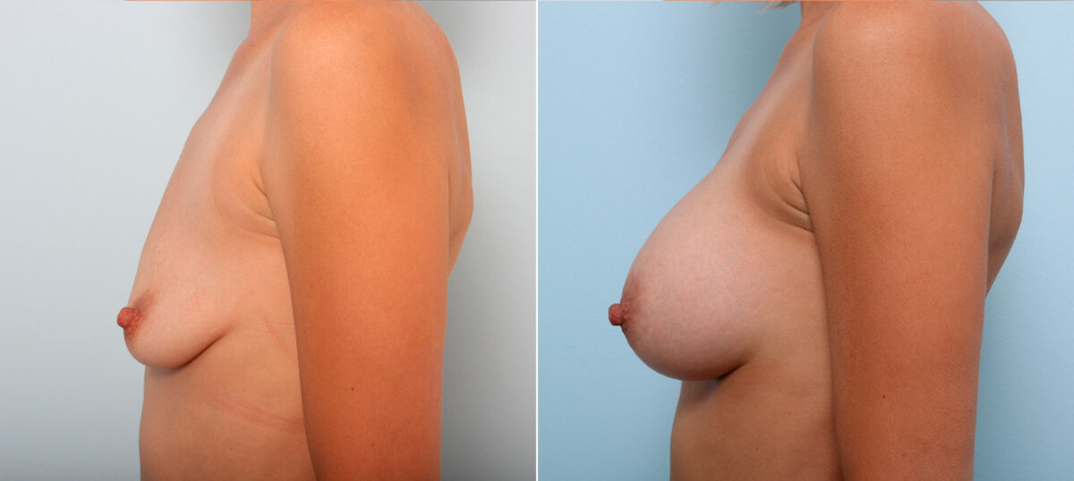 Breast Augmentation before and after photos in Houston, TX, Patient 42287