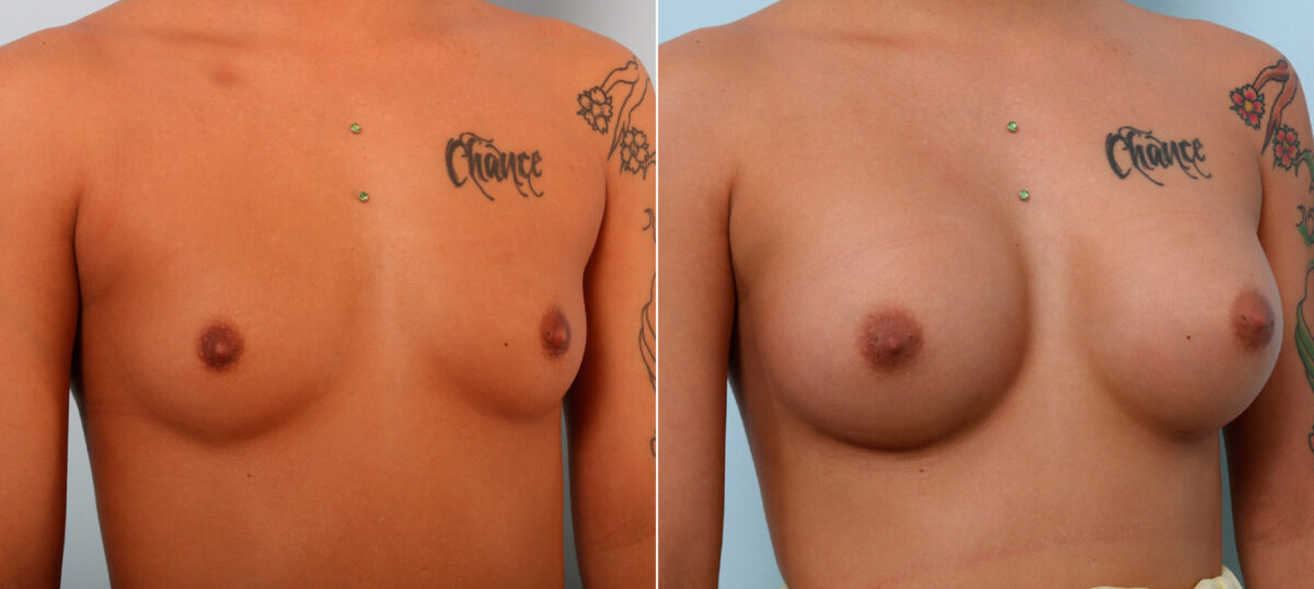 Breast Augmentation before and after photos in Houston, TX, Patient 42308