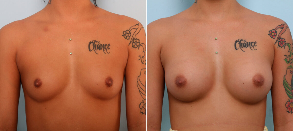Breast Augmentation before and after photos in Houston, TX, Patient 42308