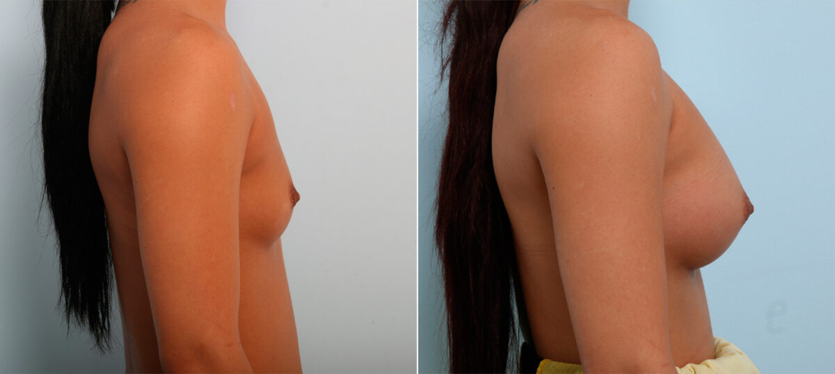 Breast Augmentation before and after photos in Houston, TX, Patient 42308
