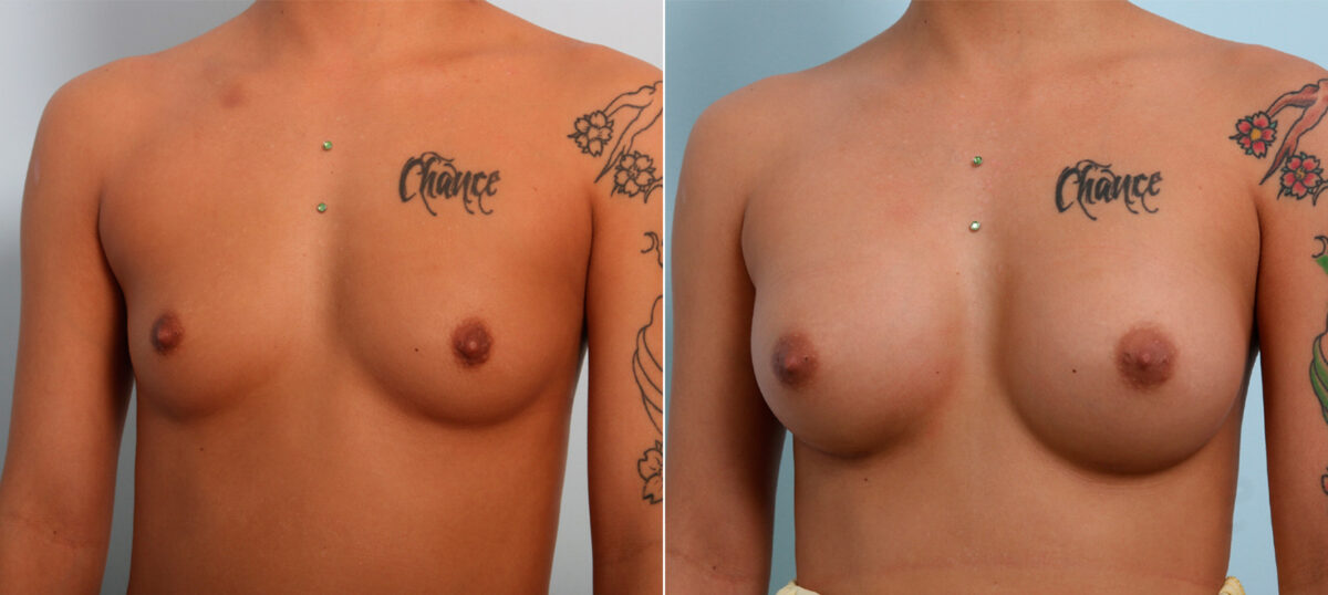 Breast Augmentation before and after photos in Houston, TX, Patient 42308