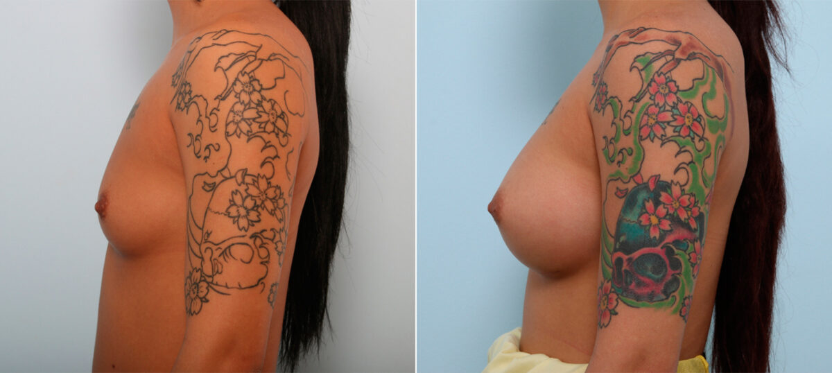 Breast Augmentation before and after photos in Houston, TX, Patient 42308