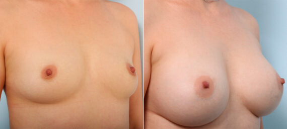 Breast Augmentation before and after photos in Houston, TX, Patient 42329