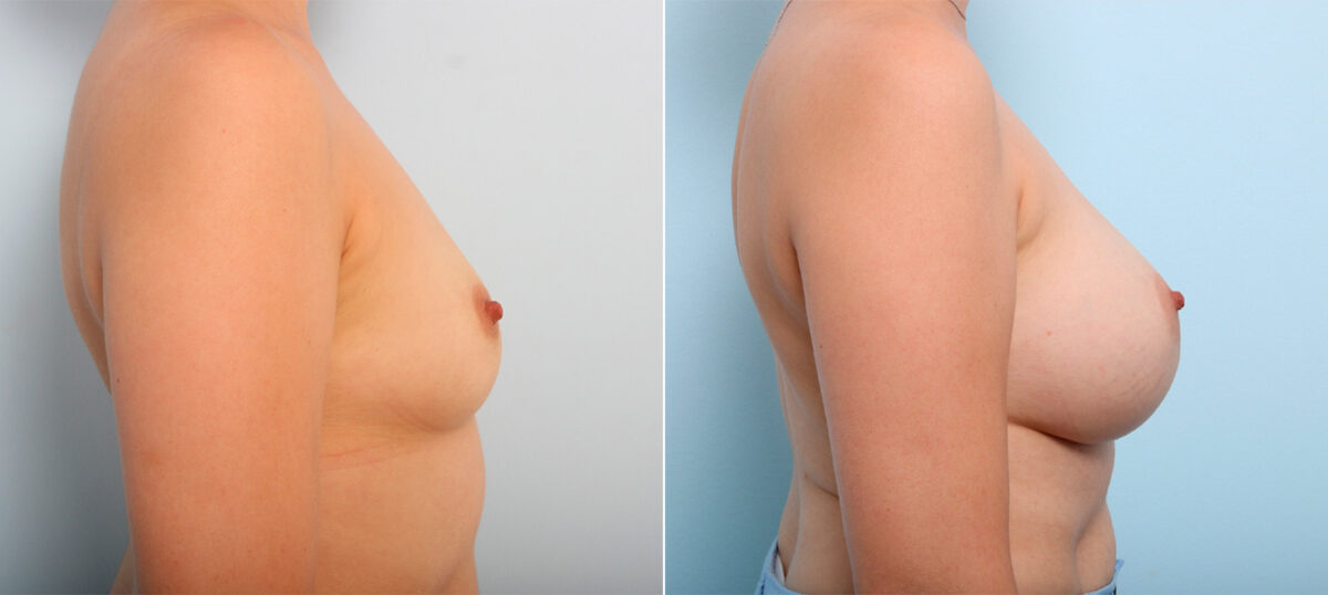 Breast Augmentation before and after photos in Houston, TX, Patient 42329