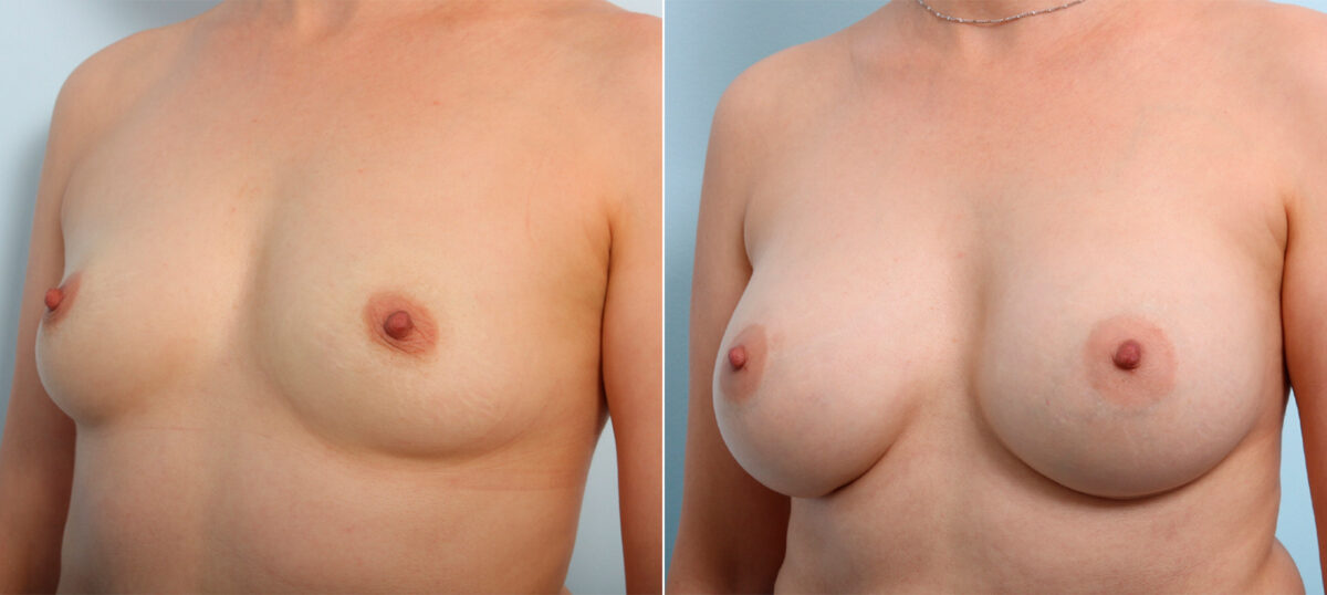 Breast Augmentation before and after photos in Houston, TX, Patient 42329