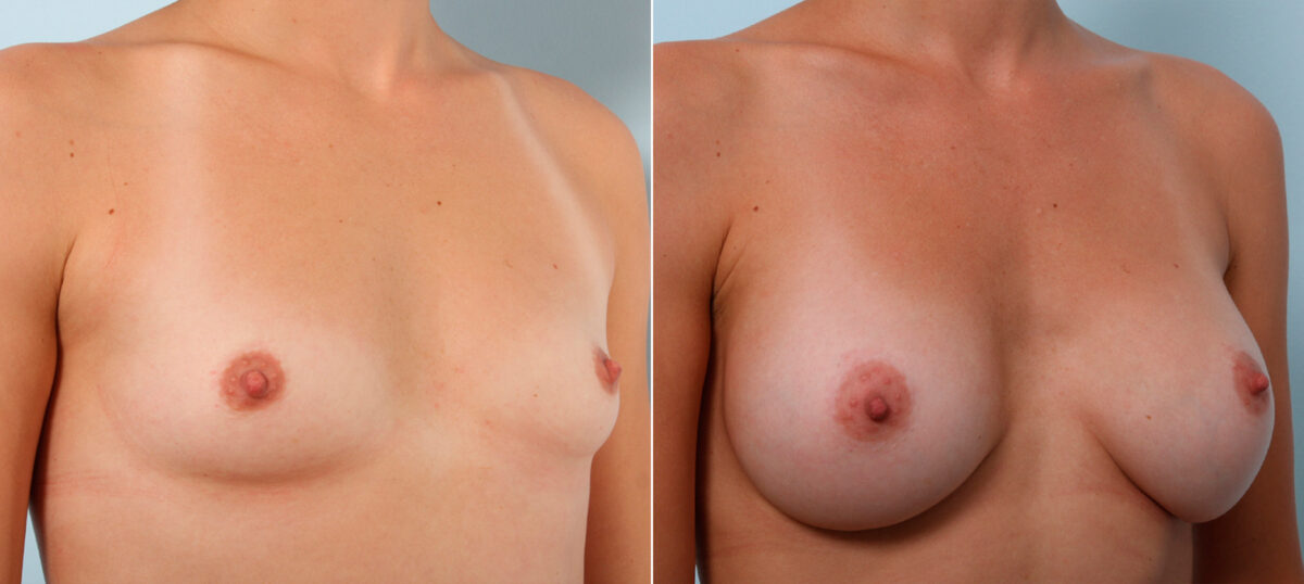Breast Augmentation before and after photos in Houston, TX, Patient 42350