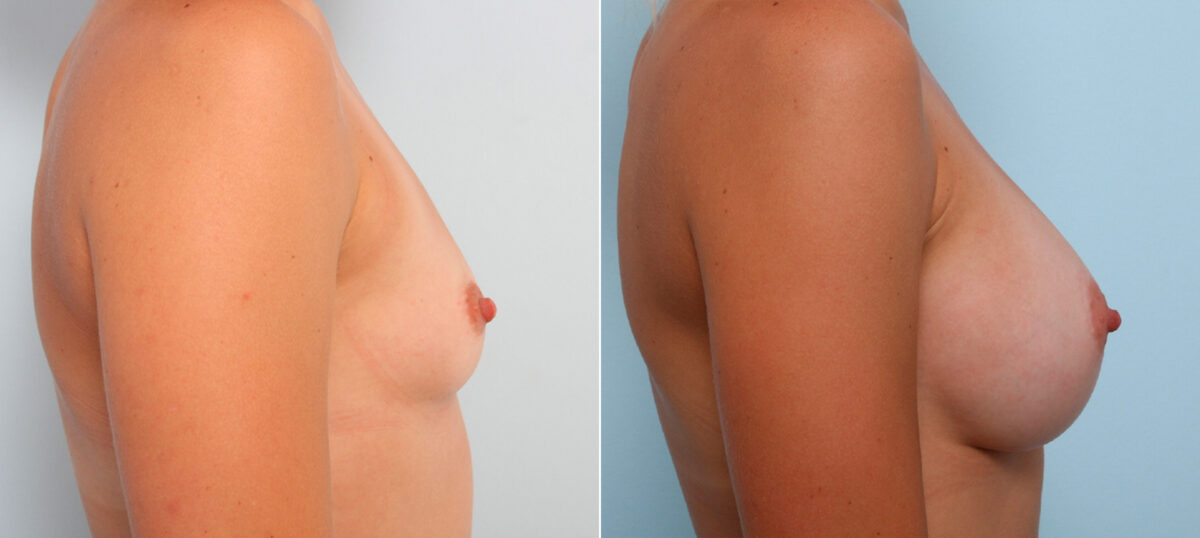 Breast Augmentation before and after photos in Houston, TX, Patient 42350