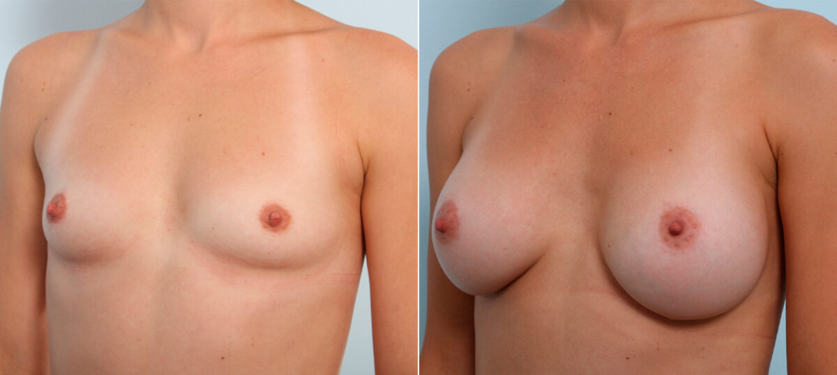 Breast Augmentation before and after photos in Houston, TX, Patient 42350