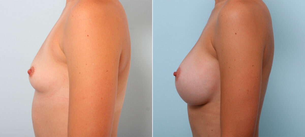 Breast Augmentation before and after photos in Houston, TX, Patient 42350