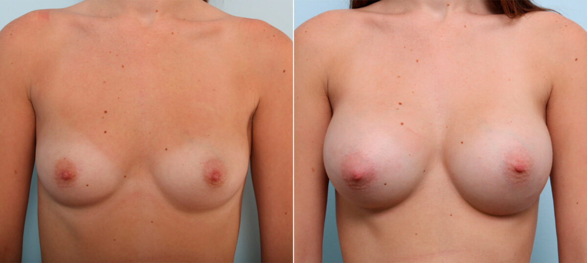 Breast Augmentation before and after photos in Houston, TX, Patient 42371