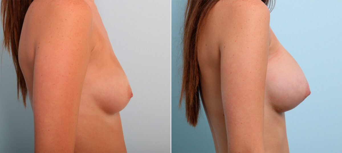 Breast Augmentation before and after photos in Houston, TX, Patient 42371