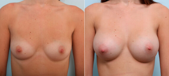 Breast Augmentation before and after photos in Houston, TX, Patient 42371
