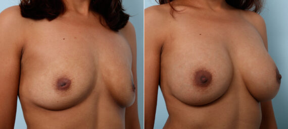 Breast Augmentation before and after photos in Houston, TX, Patient 42392