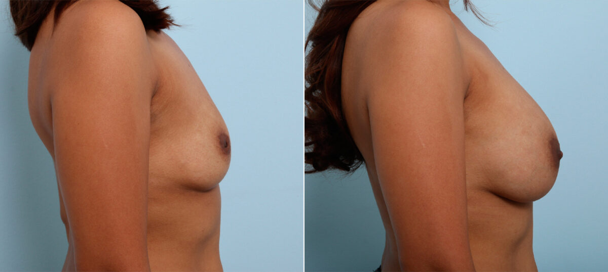 Breast Augmentation before and after photos in Houston, TX, Patient 42392