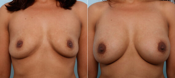 Breast Augmentation before and after photos in Houston, TX, Patient 42392