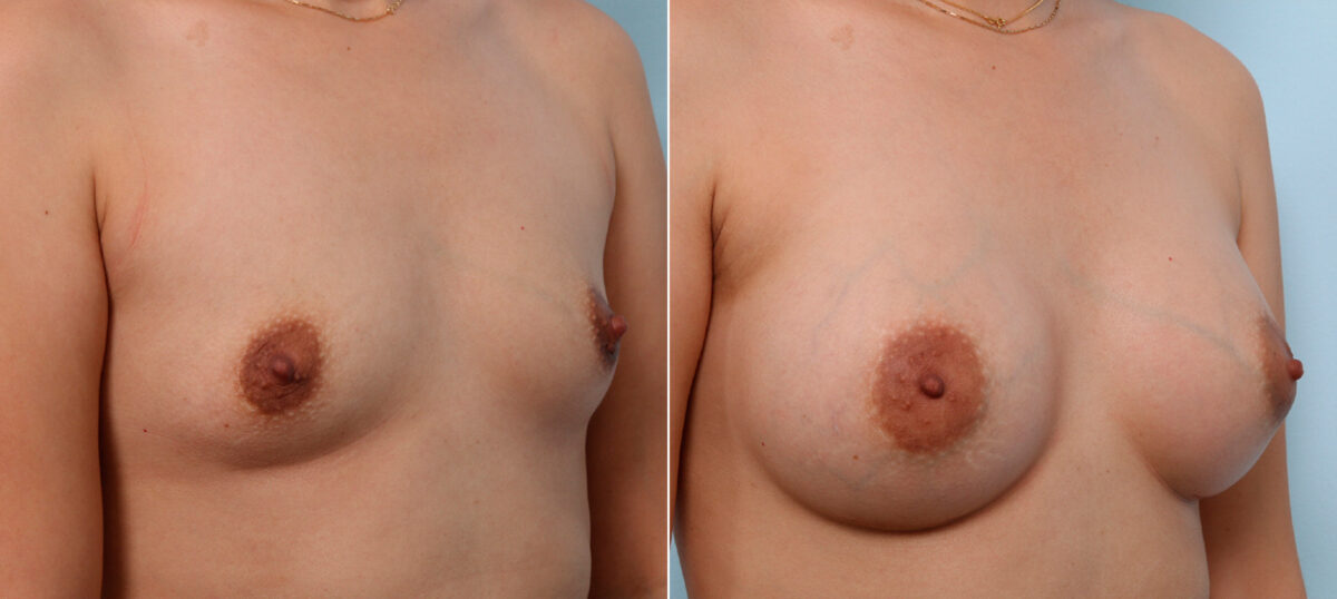 Breast Augmentation before and after photos in Houston, TX, Patient 42413