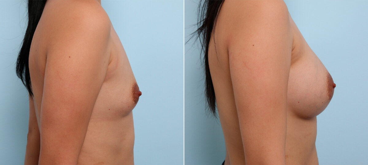 Breast Augmentation before and after photos in Houston, TX, Patient 42413