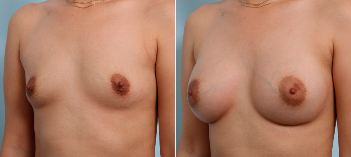 Breast Augmentation before and after photos in Houston, TX, Patient 42413