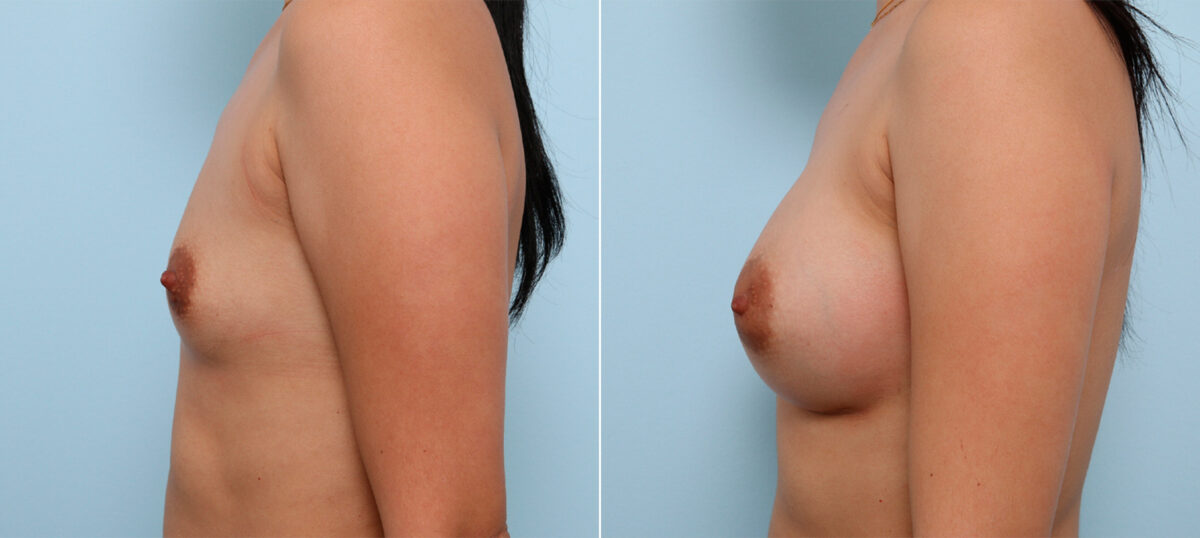 Breast Augmentation before and after photos in Houston, TX, Patient 42413