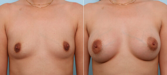 Breast Augmentation before and after photos in Houston, TX, Patient 42413