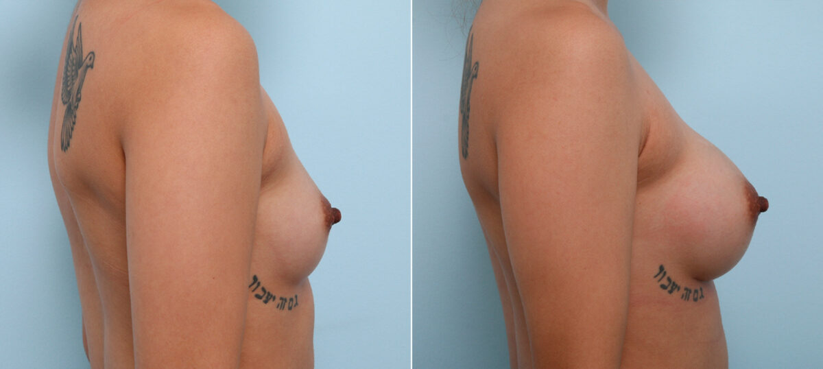 Breast Augmentation before and after photos in Houston, TX, Patient 42434